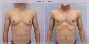 Before and after image of a mastectomy procedure.